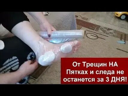 Что делать треснула пятка больно ходить