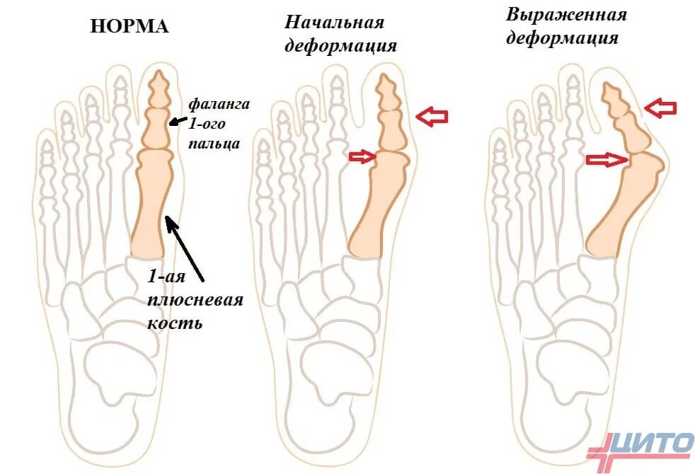 Деформация стопы