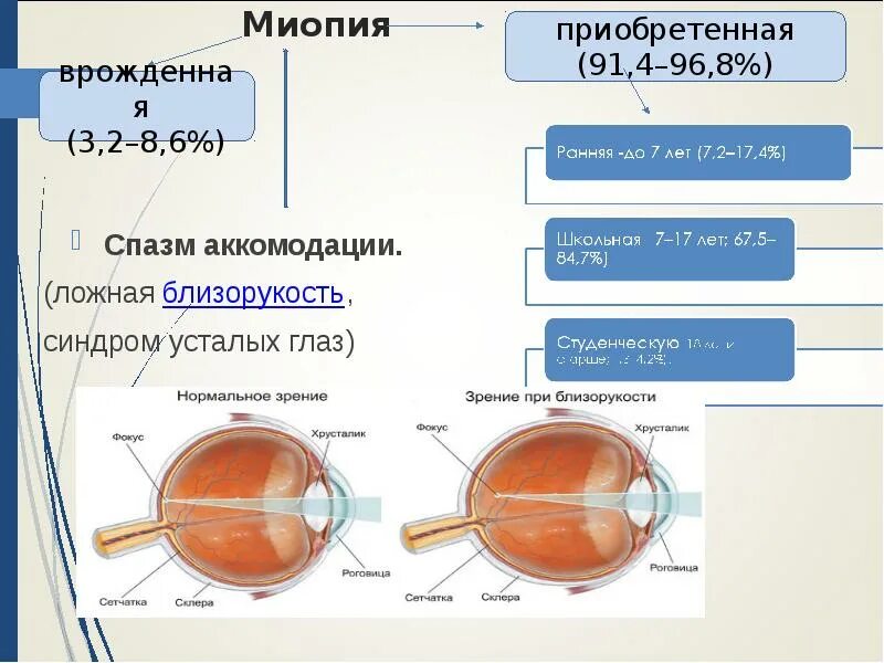 Миопия глаза высокой степени. Зрение миопия. Миопия глазное яблоко. Ложная близорукость. Ложная миопия.