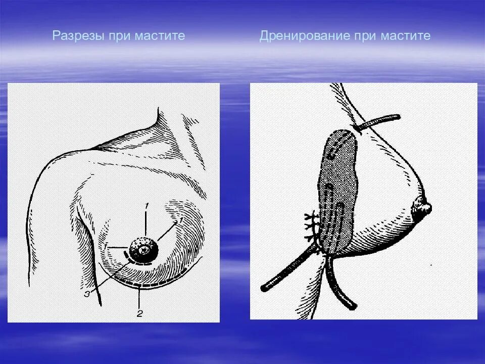 Лечение гнойного мастита. Интрамаммарный Гнойный мастит. Гнойный послеродовый мастит. Гнойный мастит операция. Дренирование молочной железы.