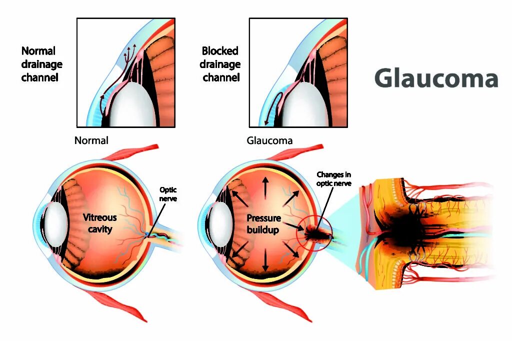 Глаукома глаза причины. Стадии первичной глаукомы. Глаукома схема глаза.