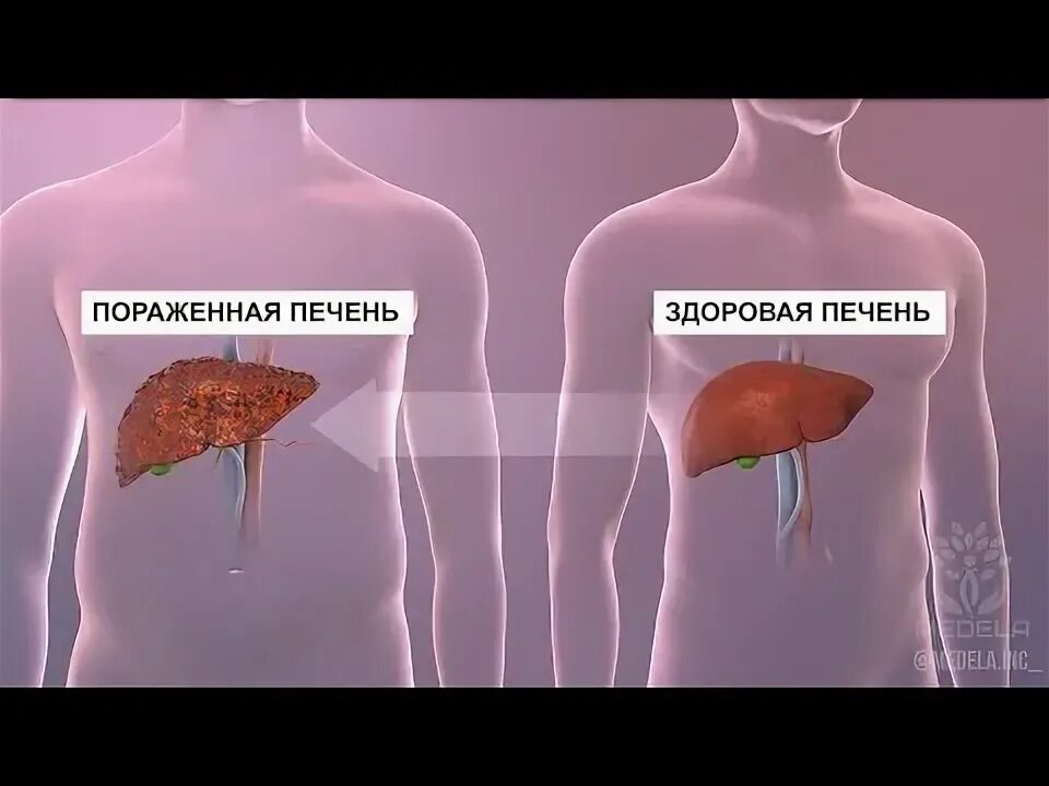 Трансплантация печени.