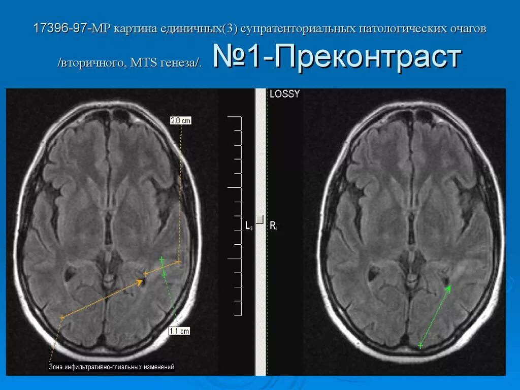 Мр признаки очагового изменения