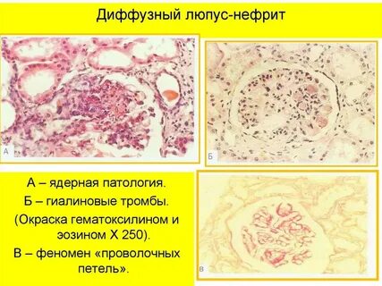 Диффузный нефрит