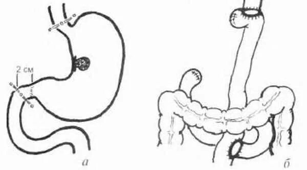 Гастроэктомия желудка операция ход операции. Схема лапароскопической резекции желудка. Гастрэктомия схема операции. Гастрэктомия желудка ход операции. Без желудка после операции