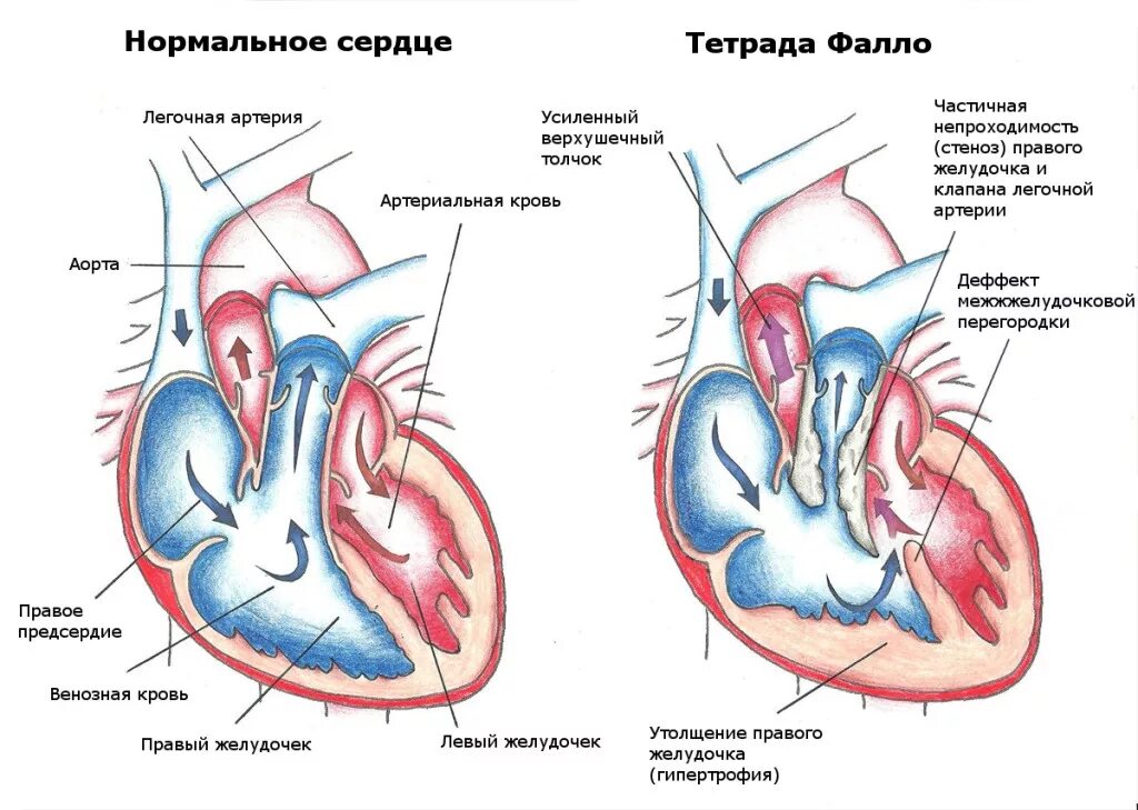 Предсердие желудка. Врожденный порок сердца Тетрада Фалло у детей. Тетрада Фалло это врожденный порок сердца. Врожденные пороки сердца гемодинамика Тетрада Фалло. Схемы врожденных пороков сердца.