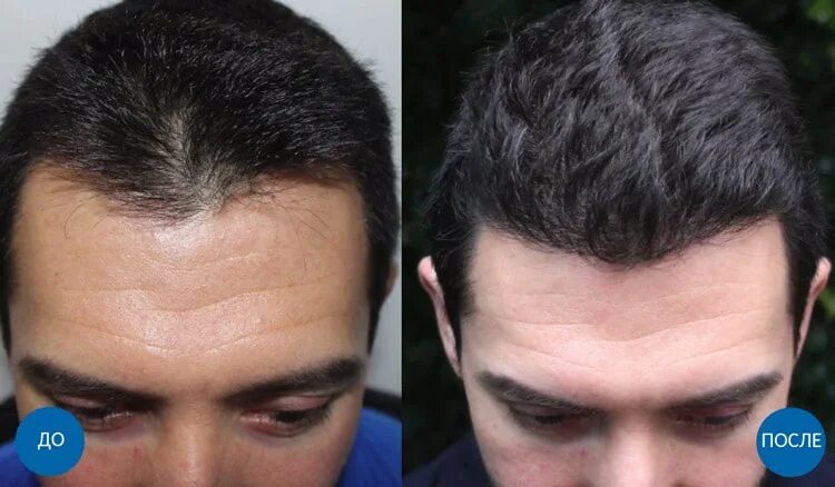 Пересадка волос до и после. Волосы после пересадки волос.