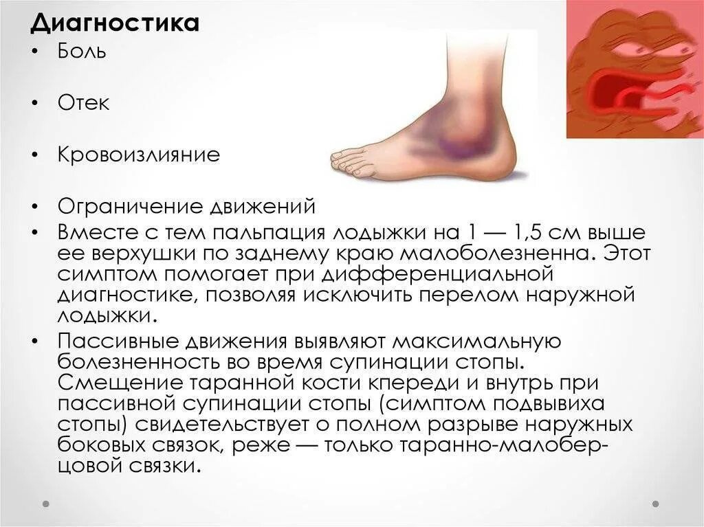 Симптомы растяжения голеностопного