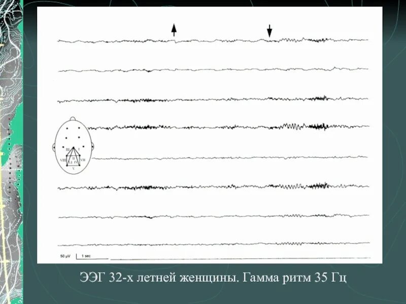 Частота ээг. Гамма ритм ЭЭГ. Гамма ритм при ЭЭГ. Гамма ритм в ЭЭГ рисунок.