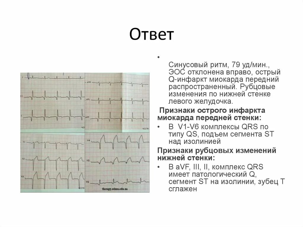 Изменения в нижней стенке левого желудочка. Синусовый ритм ЭОС горизонтальная что это. ЭКГ ритм синусовый отклонение ЭОС. Ритм синусовый ЭОС вправо. Рубцовые изменения по нижней стенке.