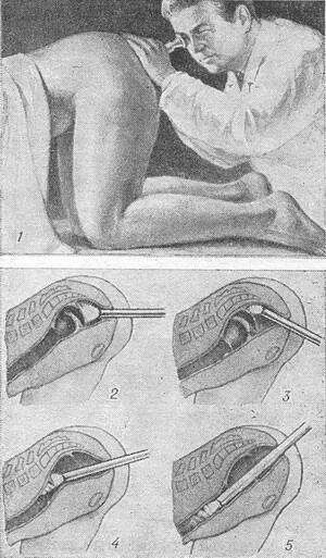 Ректальный человек. Окципитальная пункция. Пальцевое ректальное исследование предстательной железы. Ректороманоскопия коленно локтевое положение. Пальцевое ректальное исследование матки.