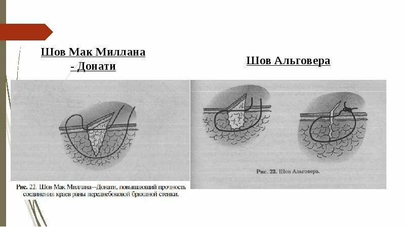 П образный вертикальный шов по донати. Вертикальный матрацный шов в хирургии. Шов по донати техника. Вертикальный узловой матрацный шов. Вертикальный узловой матрацный шов.