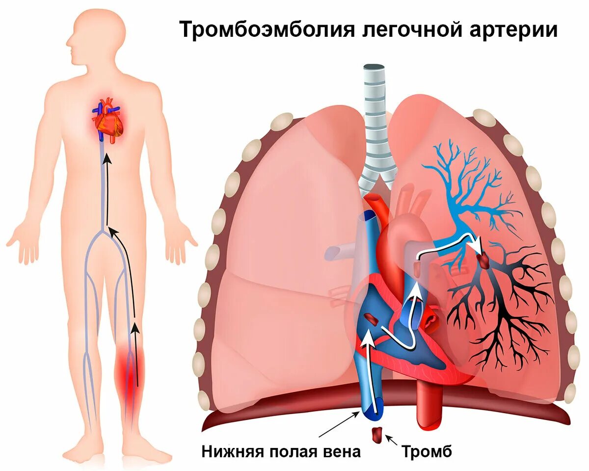 Тромбозы и эмболии артерий. Тромбоэмболия легочной артерии. Тромбоэмболия легочной артерии (Тэла). 1. Тромбоэмболия лёгочной артерии. Тромбоэмболия а8 легочной артерии.