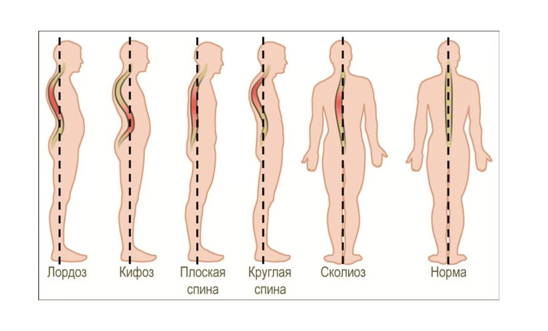 Типы нарушения осанки кифоз лордоз. Кифоз лордоз и сколиоз позвоночника. Осанка лордоз кифоз сколиоз. Виды искривления позвоночника лордоз кифоз сколиоз. Изгиб позвоночника 6