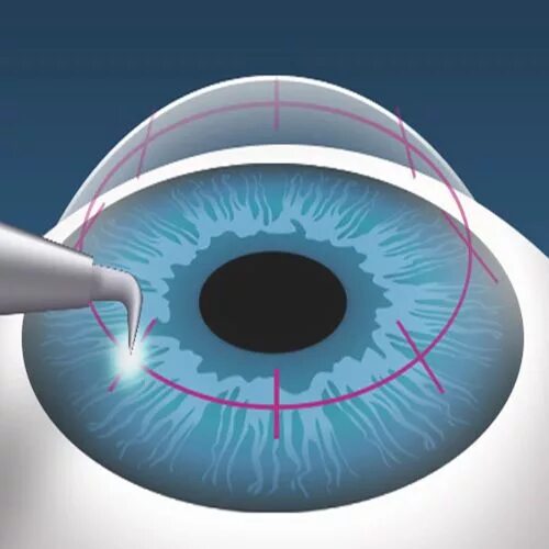 Донор зрение. Кератопластика роговицы глаза. Кератопластика операция. Кератопротез роговицы. Трансплантация роговицы (кератопластика).