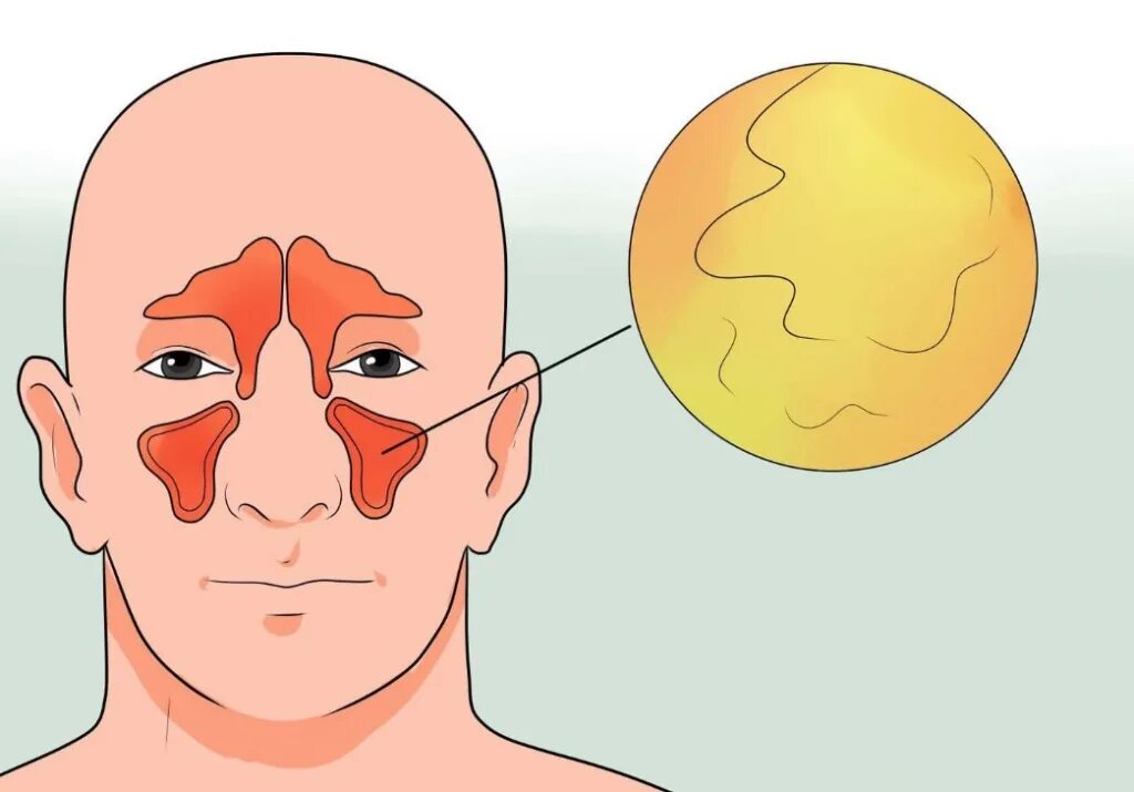 Синусит гайморит фронтит. Гайморовы пазухи гайморит хронический. Острые и хронические синуситы. Заболевания головные заболеваниях носа