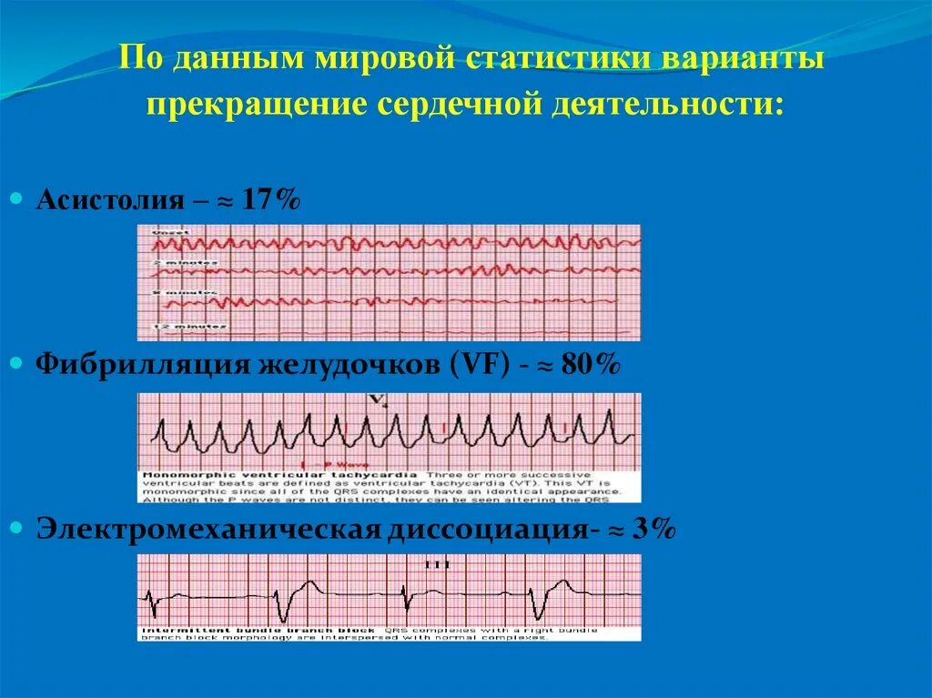 Асистолия сердца это. Асистолия и фибрилляция желудочков. Фибрилляция асистолия электромеханическая диссоциация. Электромеханическая диссоциация на ЭКГ. Электромеханическая диссоциация сердца на ЭКГ.