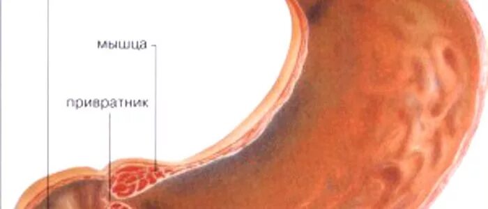 Кто такой привратник. Рубцовый стеноз привратника. Язва привратника желудка. Язвенная болезнь желудка стеноз. Стеноз пилорического отдела желудка.