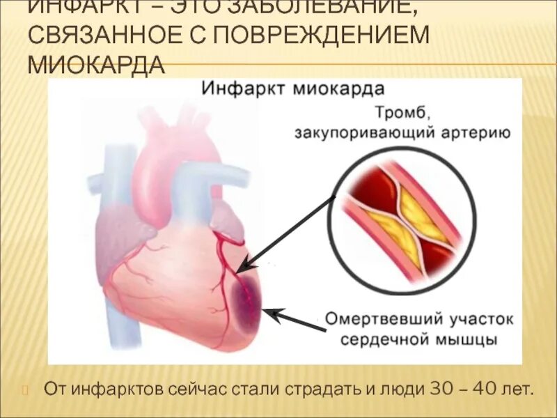 Повреждение миокарда сердца. Повреждение миокарда сердца