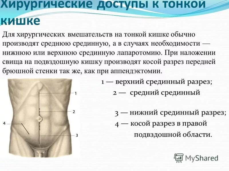 верхняя срединная лапаротомия