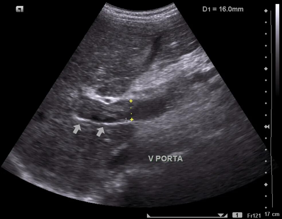 Тромбоз воротной вены на УЗИ. Воротная Вена печени на УЗИ. Тромбоз портальной вены УЗИ. Тромбоз воротной вены УЗИ картина. Тромбоза вен печени