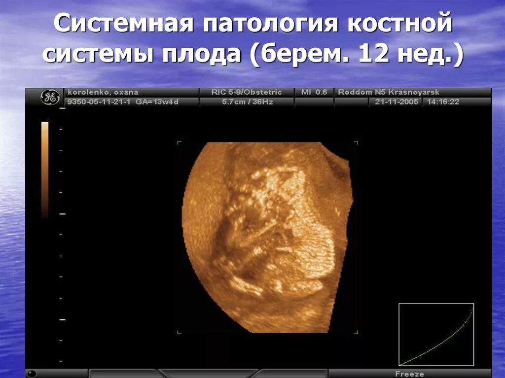 Системные аномалии. Системные аномалии. Классификация врожденных пороков развития. Серьезная системная патология. Антифосфолипидный синдром диагностика при скв.