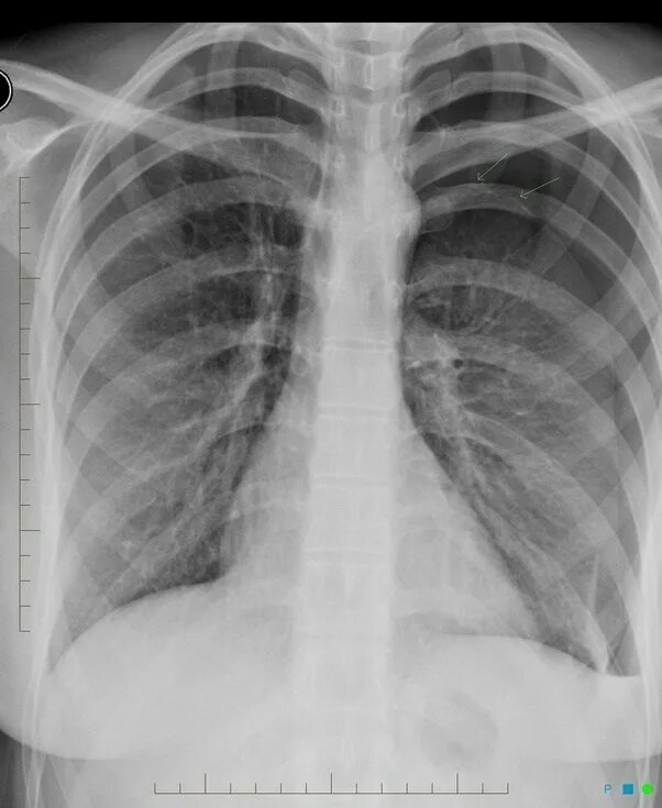 Сколько в ребре воды. Коллапс легкого рентген. Жесткий снимок грудной клетки. Функциональная рентгенография грудной клетки. Рентген грудной клетки что показывает.