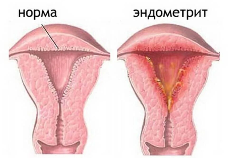 Эндометрит (воспаление слизистой оболочки матки);. Послеродовой эндометрит матка. Слизистая хронический эндометрит. Причина эндометрии у женщин