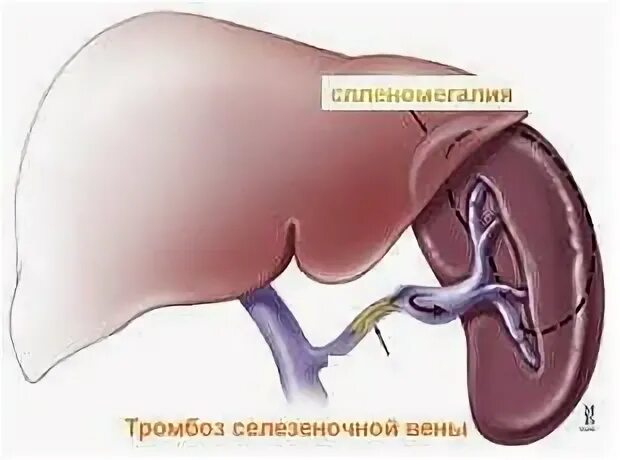 Спленомегалия селезенки. Тромбоз вен печени и селезенки. Тромбирована селезеночная Вена. Тромбоэмболия селезенки.