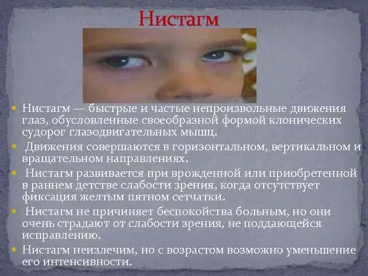Непроизвольное движение глазных яблок. Непроизвольное движение глазных яблок