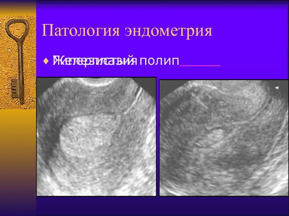 Полип эндометрия в матке причины. Амк гиперплазия эндометрия. гиперплазия эндометрия мфя. патология эндометрия гиперплазия. очаговая гиперплазия эндометрия полипа.