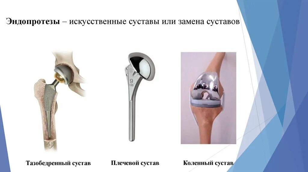 Эндопротезирование тазобедренного сустава ход операции. Классификация эндопротезирования тазобедренного сустава. эндопротез сустава. эндопротез тазобедренного сустава элементы. типы эндопротезов тазобедренного сустава.