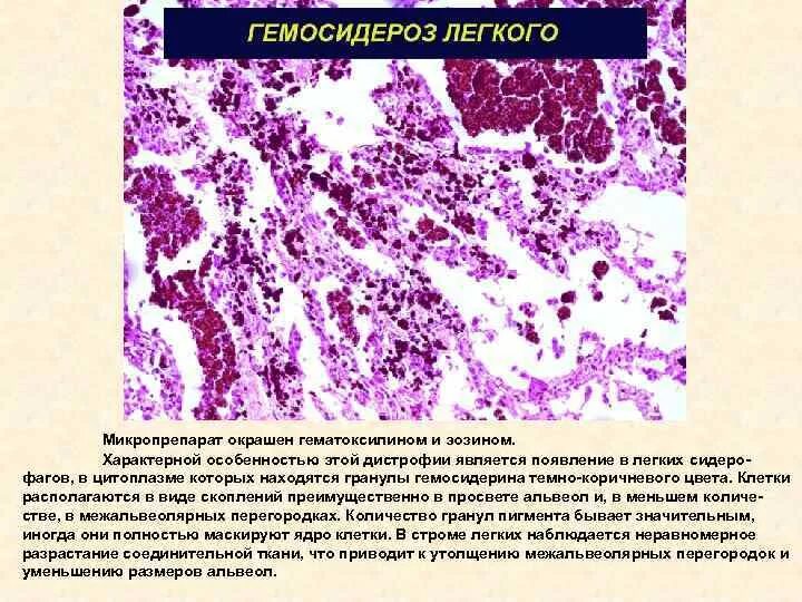 Гемосидероз лёгкого микропрепарат. Гемосидероз легкого патологическая анатомия. Гемосидероз легкого микропрепарат. Гемосидероз легких микропрепарат описание. Печень микропрепарат описание