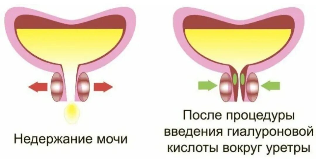 Недержание у женщин. Эндоуретральное Введение гиалуроновой кислоты. Недержание мочи. Введение гиалуроновой кислоты в уретру.