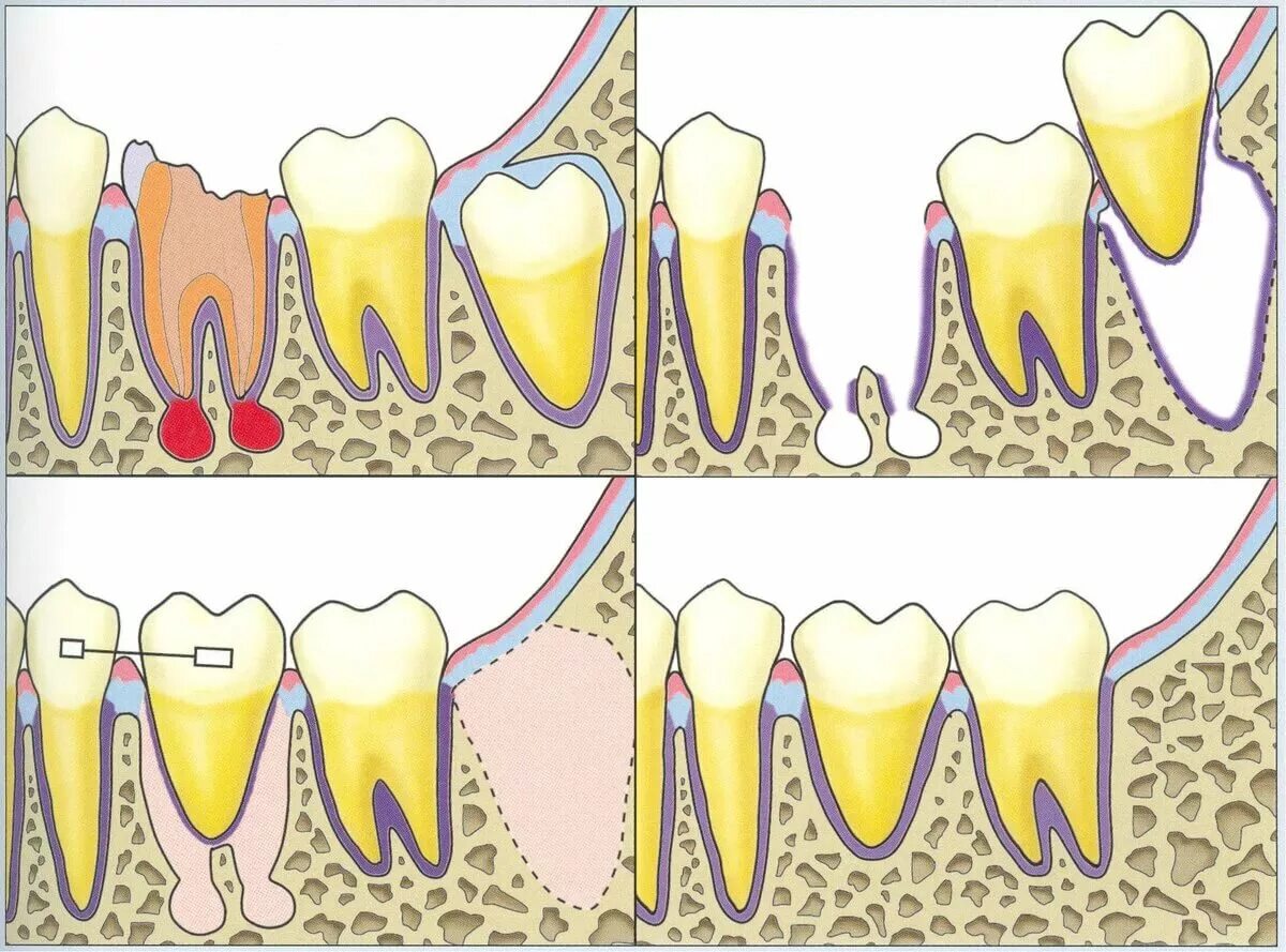 Сложное удаление зуба. Витальная реплантация зуба. Операция реплантации зуба. Реплантация зуба в стоматологии. Полный вывих зуба реплантация.