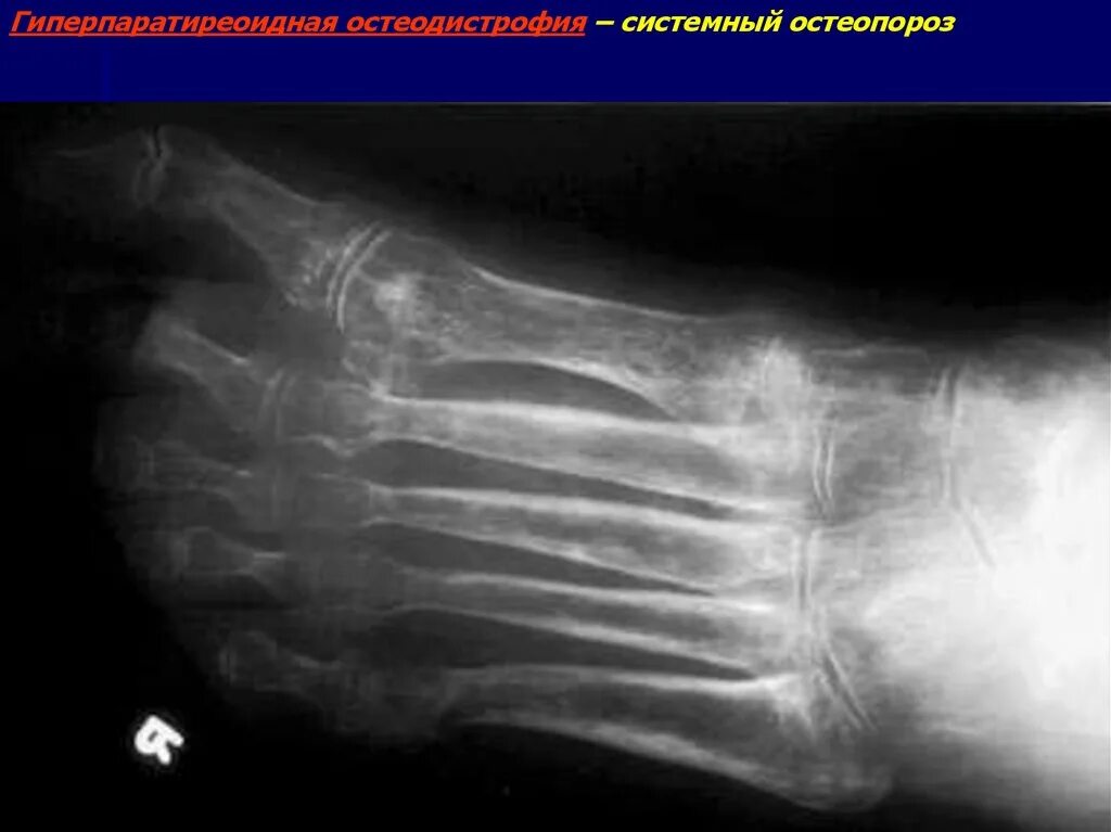 Синдром зудека лечение. Пятнистый остеопороз на кт. Остеопороз стопы рентген. Регионарный остеопороз стопы. Пятнистый остеопороз Зудека.