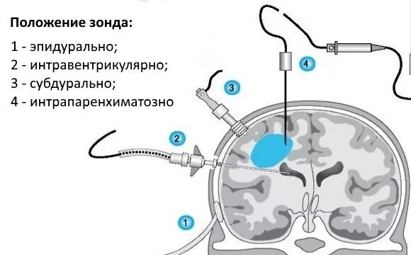 Внутричерепное давление у грудничков (ВЧД): симптомы, диагностика, лечение