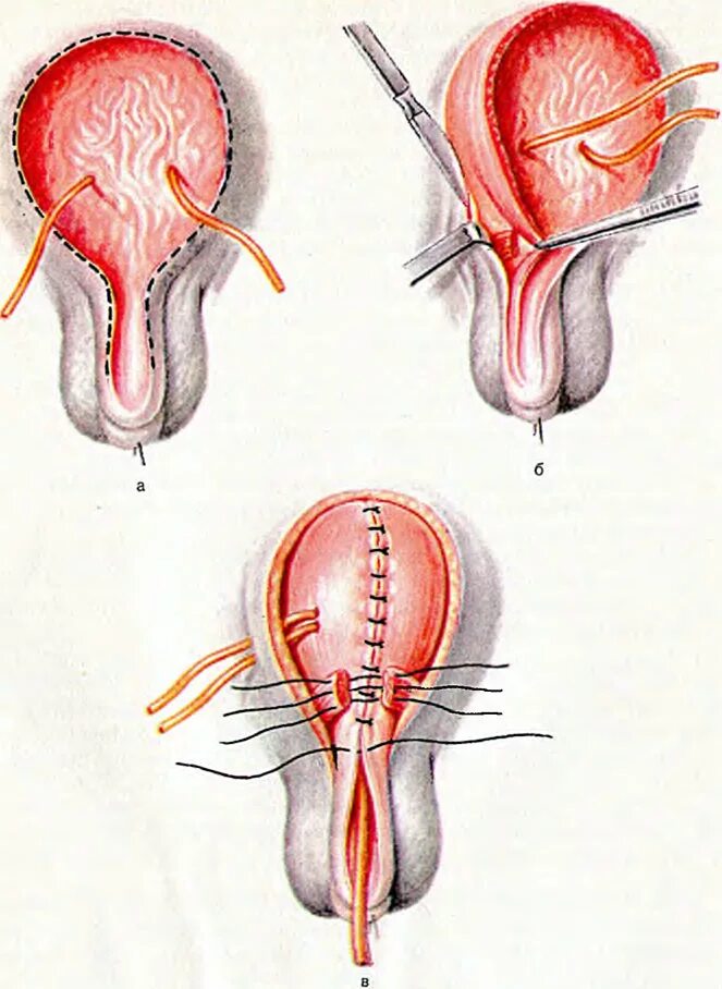 Опущение мочевого пузыря операция