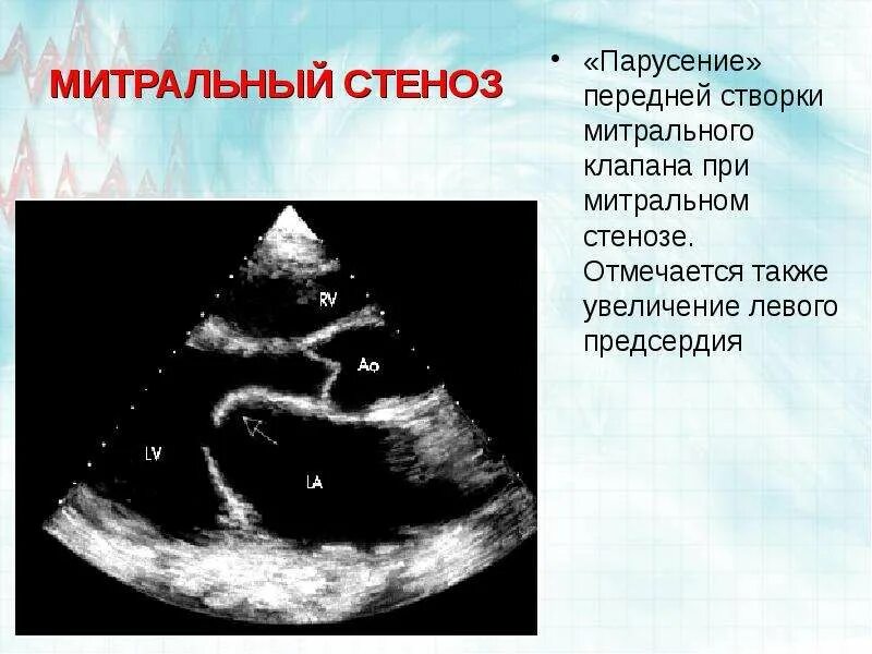 Пролапс трикуспидального клапана эхокг. Узи сердца клапан. Недостаточность митрального клапана эхокг. Недостаточность митрального клапана эхокг. Пролапс митрального клапана узи степени.