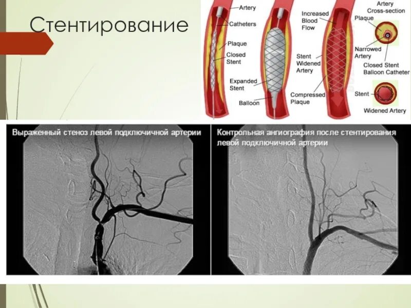 Стентирование сосудов последствия. Стентирование подключичной артерии. Коронарография сосудов стентирование. Коронароангиография стентирование. Стентирование коронарных сосудов осложнения.