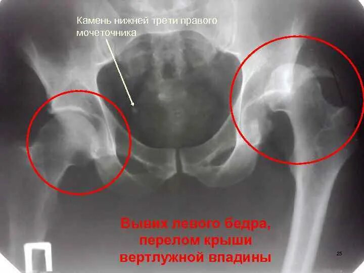 Перелом вертлужной впадины рентген. Перелом дна вертлужной впадины на рентгене. Трещина вертлужной впадины рентген. Вертлужная впадина тазобедренного сустава.