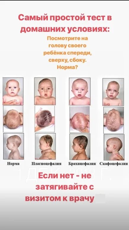 Форма головы у грудничка 4 месяца норма. Форма черепа у грудничка 4 месяца. Форма черепа у новорожденного норма в 1 месяц. Форма черепа в 3 месяца у ребенка.