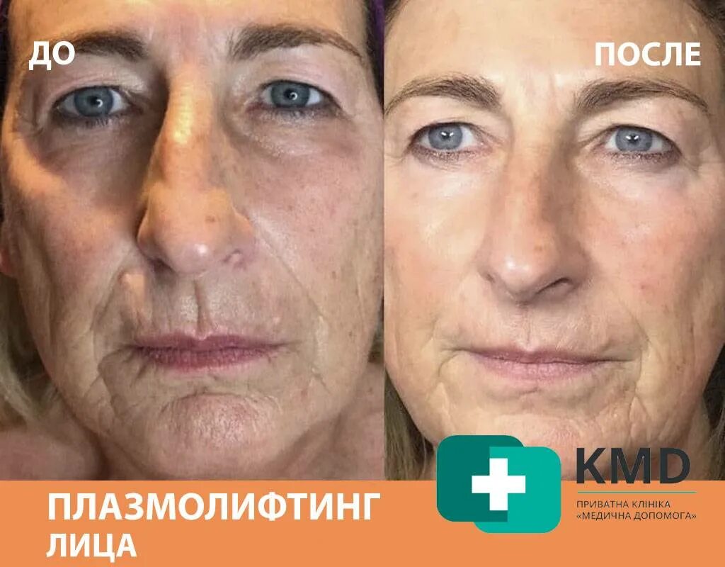 Плазмолифтинг плюс. Плазмотерапия для омоложения. Плазмолифтинг для лица. Плазмолифтинг плюс. Плазмотерапия для лица плюсы и минусы.