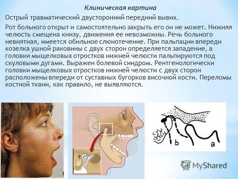 Больно открывать рот. Двусторонний вывих нижней челюсти. Двусторонний передний вывих нижней челюсти. Односторонний вывих нижней челюсти характеризуется. Острый вывих нижней челюсти.