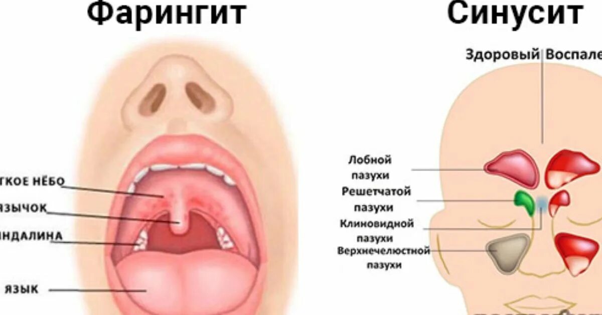 Сильно болит горло и ухо. Фарингит тонзиллит синусит. Воспаление миндалин лимфоузлы. Воспаленное горло у ребенка.