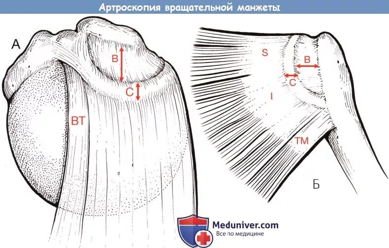 Операция на сухожилиях плечевого сустава