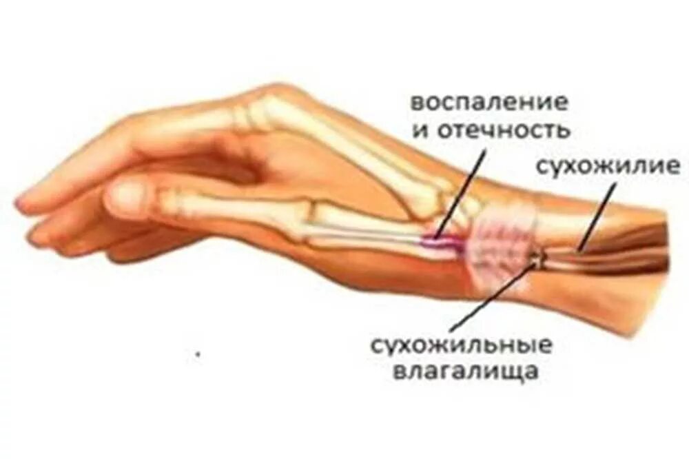 Сколько заживает сухожилие. Тендинит и тендовагинит. Тендинит сухожилия пальца кисти. Туберкулезный тендовагинит. Крепитирующий тендовагинит.