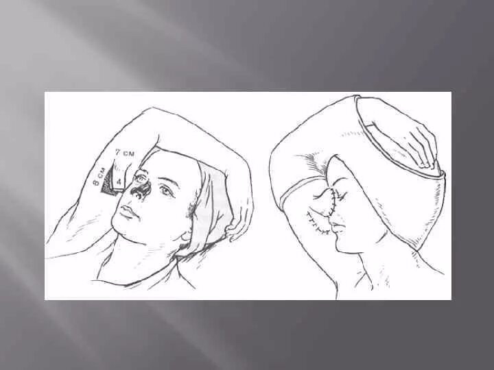 Пласт или лоскут свежего. Василек лоскуты ткани. Пласт или лоскут свежего. Пласт или лоскут свежего. Ротация лоскута на ножке со щеки.