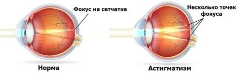 Сложный миопический астигматизм глаз