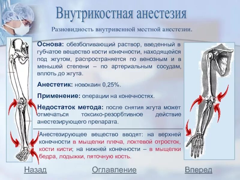 Внутрикостная блокада. Внутрикостная анестезия техника проведения. Техника внутривенной регионарной анестезии. Внутрикостная местная анестезия. Методика внутрикостной анестезии.